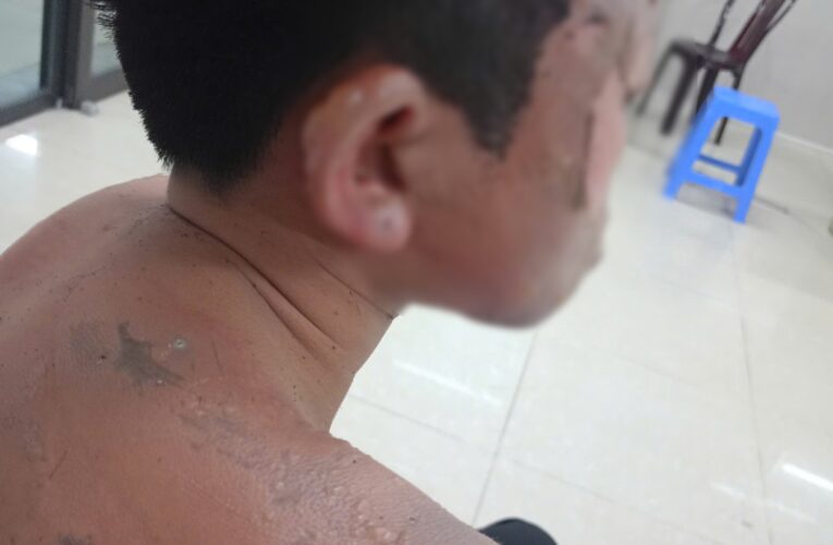 Ninh Bình: Cháu bé 12 tuổi bỏng nặng do đ,ốt ph.áo